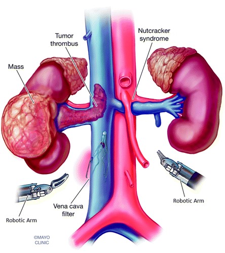 Ρομποτική ριζική νεφρεκτομή με ταυτόχρονη αφαίρεση καρκινικού θρόμβου από την νεφρική ή/και κάτω κοίλη φλέβα. Εξέλιξη της Πρωτοποριακής επέμβασης στο Ιατρικό Αθηνών